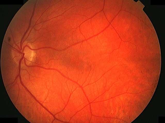 retinopathy