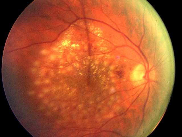Joslin researchers find drugs are effective for diabetic macular edema in new trial